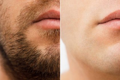 how-to-find-the-best-laser-hair-removal-for-men-in-chicago